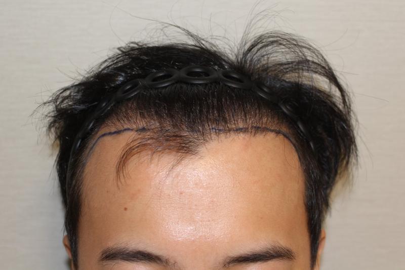 수술전 1.jpg