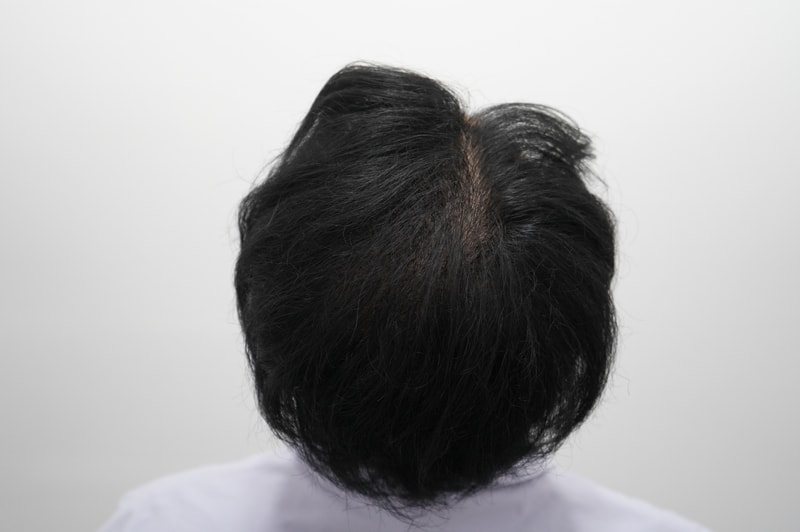 모아트 1400모낭 모발이식 3주차 후기