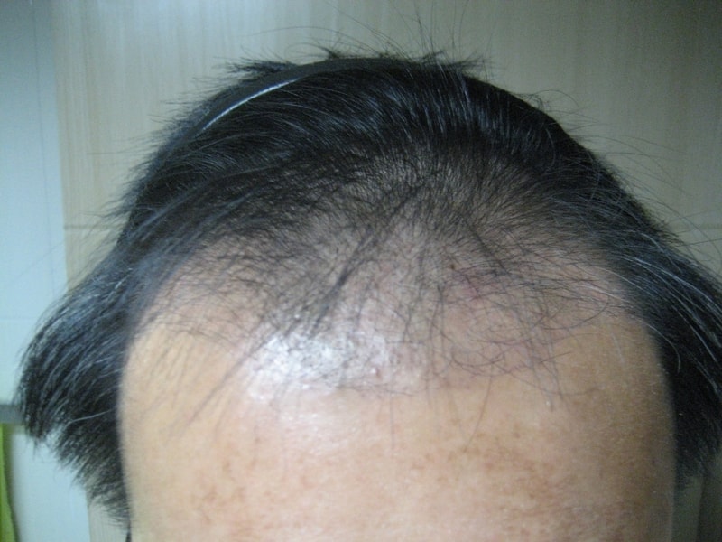 20151116수술100일후.jpg