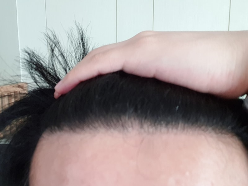 모재성 8개월 경과
