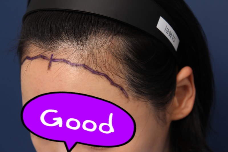 [꾸미기]박연수 수술전-1.JPG