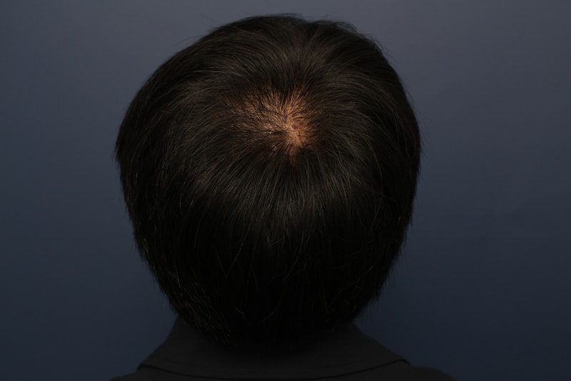 수술전 정수리.JPG