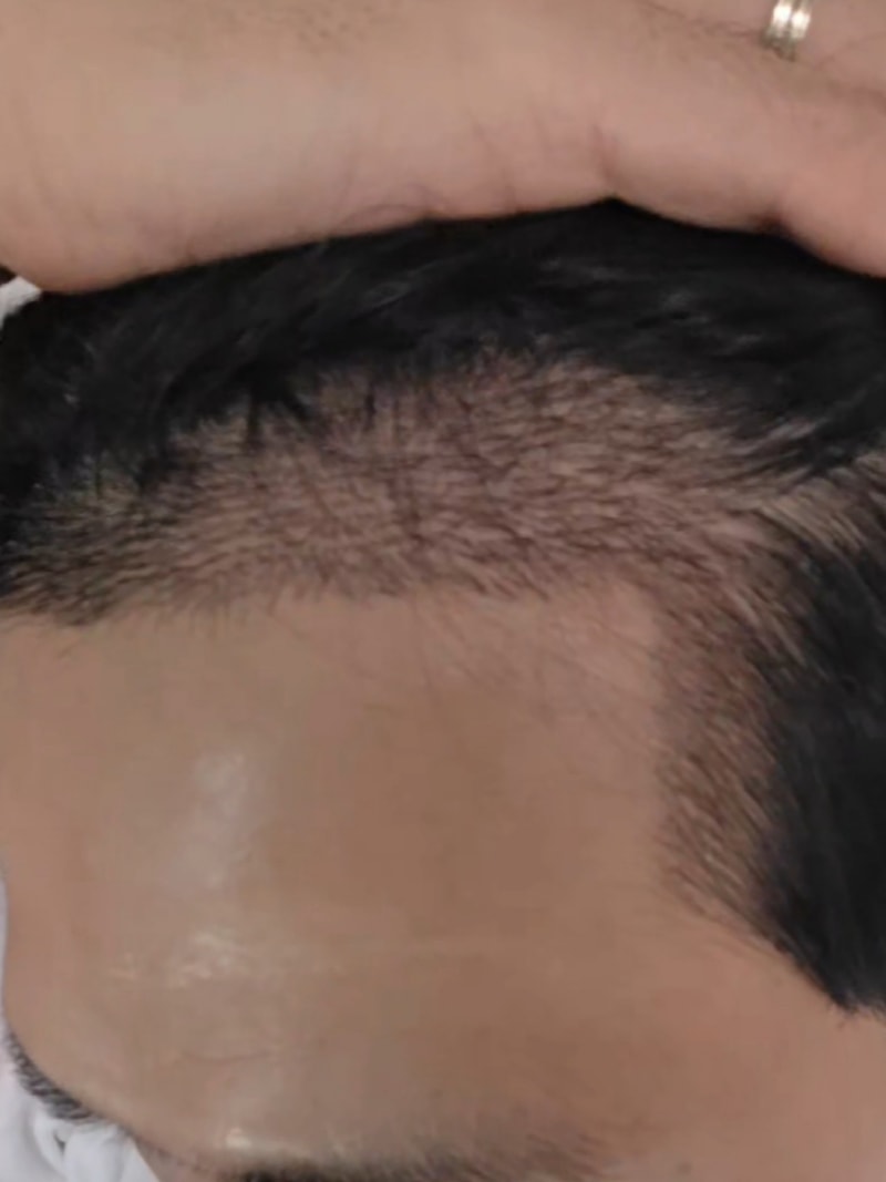 THE BEAUTY非切开3300毛，完美矫正M字与不对称太阳字后记