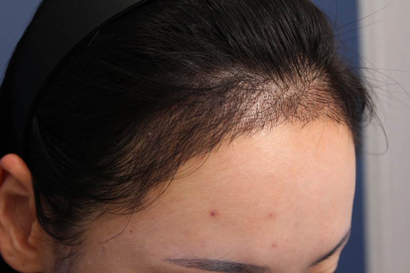 박연수 수술 16일차 3.JPG