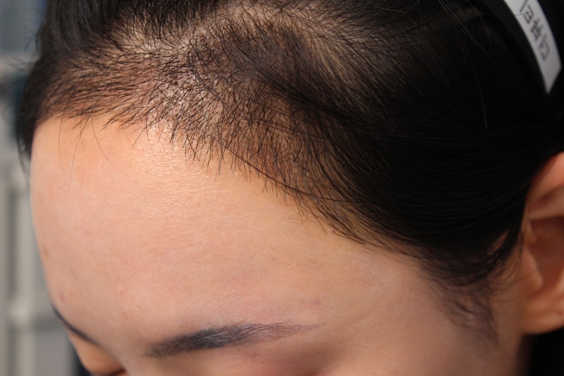 박연수 수술 16일차 1.JPG