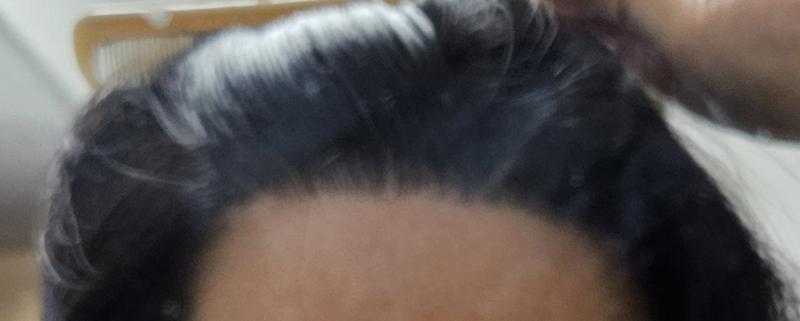 It's been a long time. It's the 4th year of hair transplantation