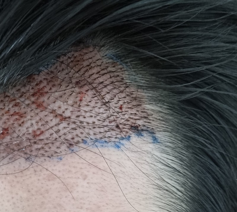 Mo Plus) Day 2 of hair transplantation