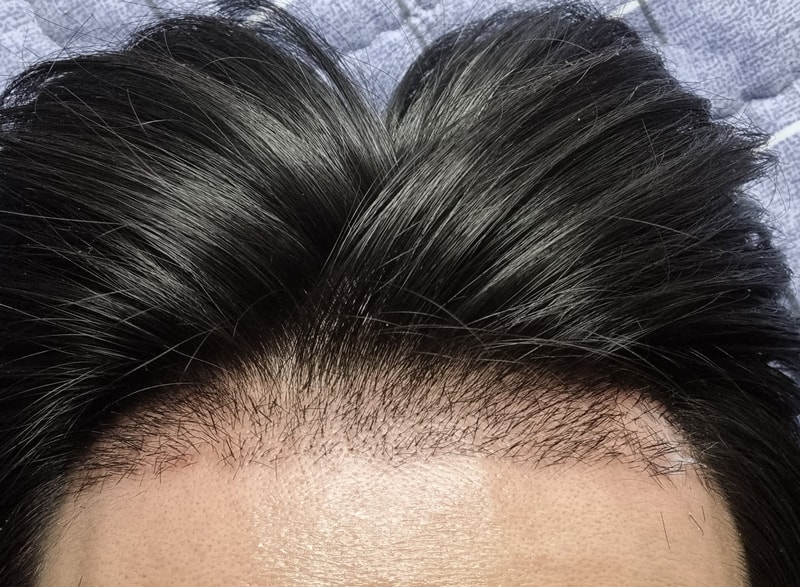 Day 16 of the hair transplant It's already dark