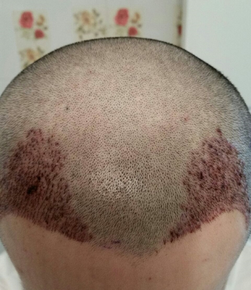 Forehead 1200 Hair follicle CIT Cut Day 2