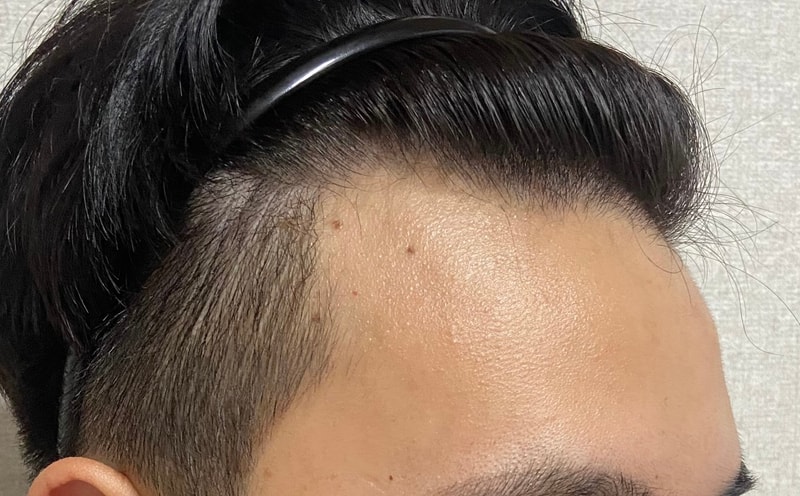 모발이식 전 측면사진.jpg