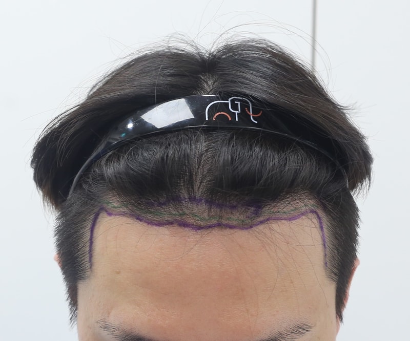 狎鴎亭 マンモス 非切開 スリット ヘアライン