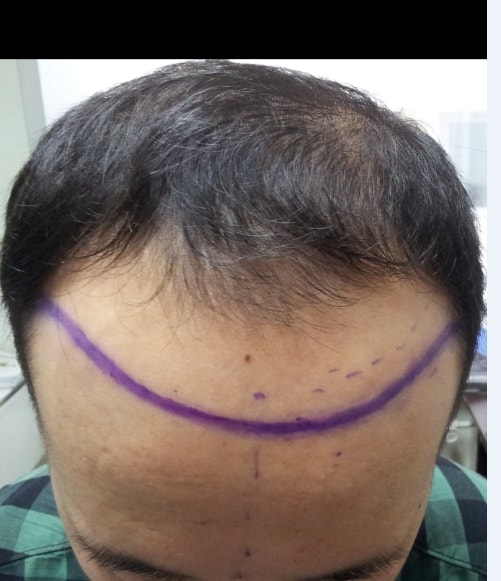 이마라인모낭심기_00004.jpg
