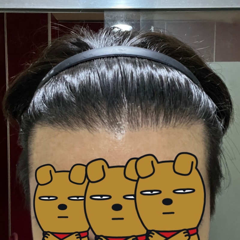 New hair incision 1950 hair follicle 1 year later