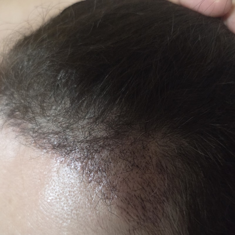A review of women's soccer field forehead Hair Transplant