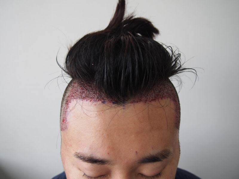 수술 후 정면.JPG