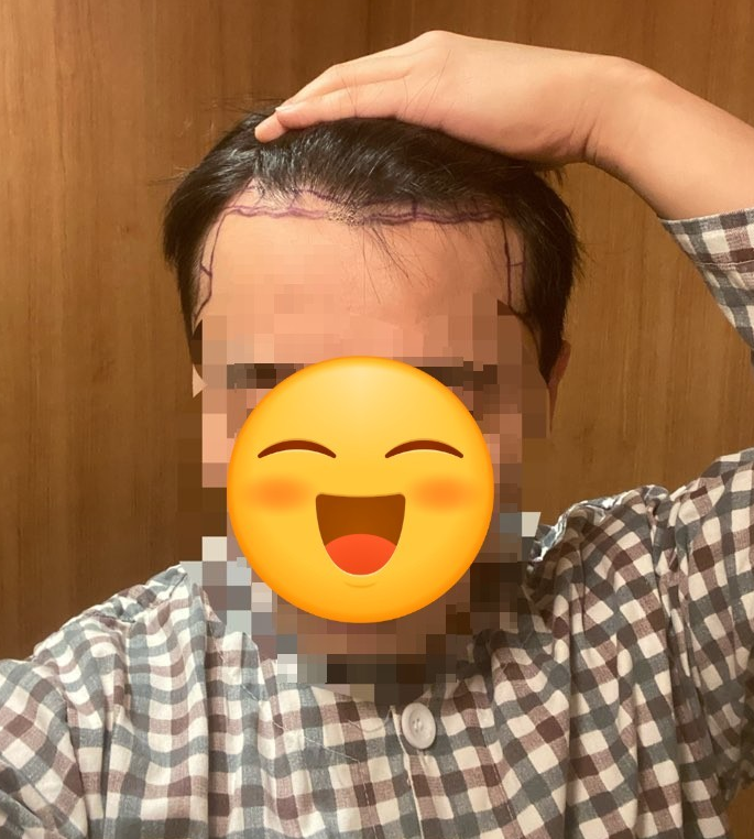 수술전 디자인.PNG