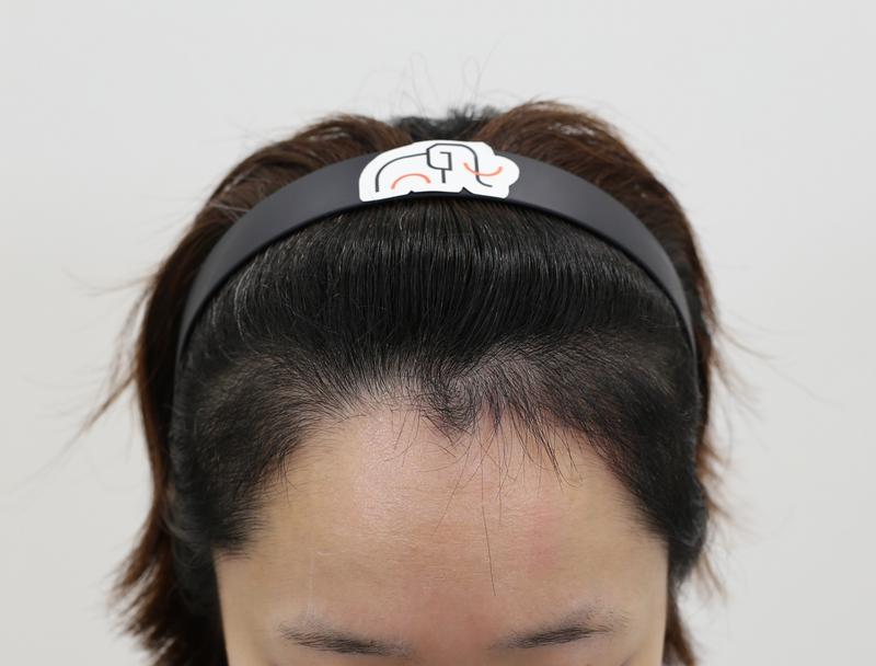 [Hairline] Apgujeong Mamos Women's Hairline 4 Months Review