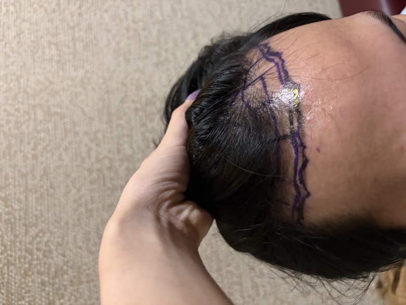 뉴헤어 절개 1800모낭(3600모) 8일차 후기입니다