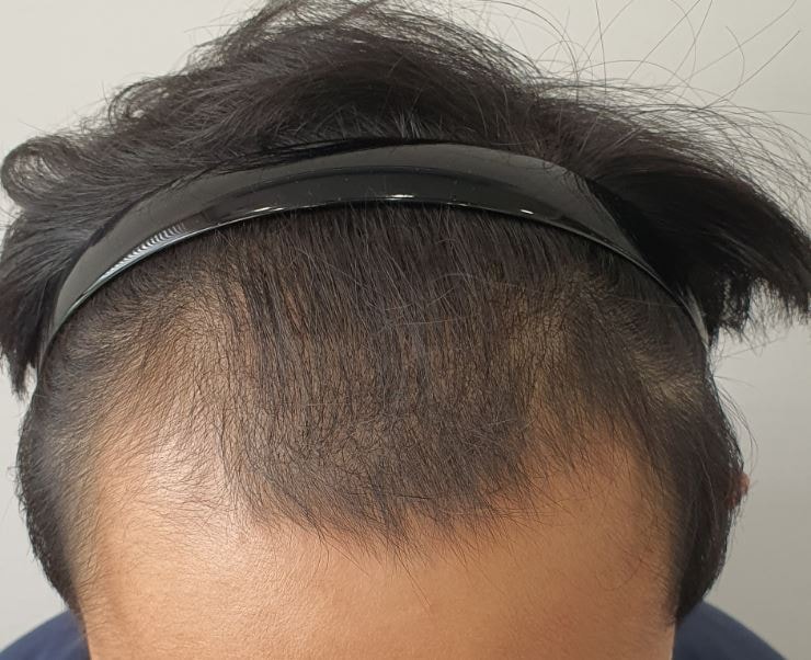 [8 months old] It's a review of hair transplantation