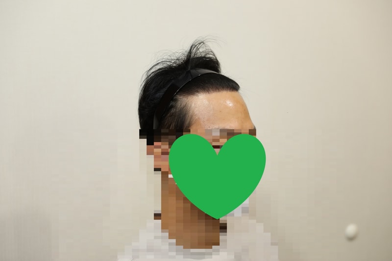 수술 1년차 우측.jpg