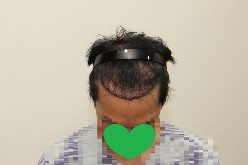 수술당일 위쪽.jpg