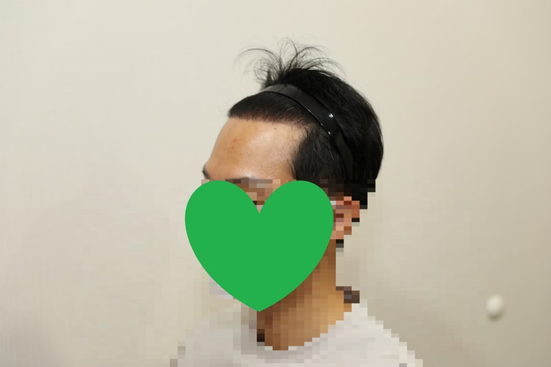 수술 1년차 좌측.jpg