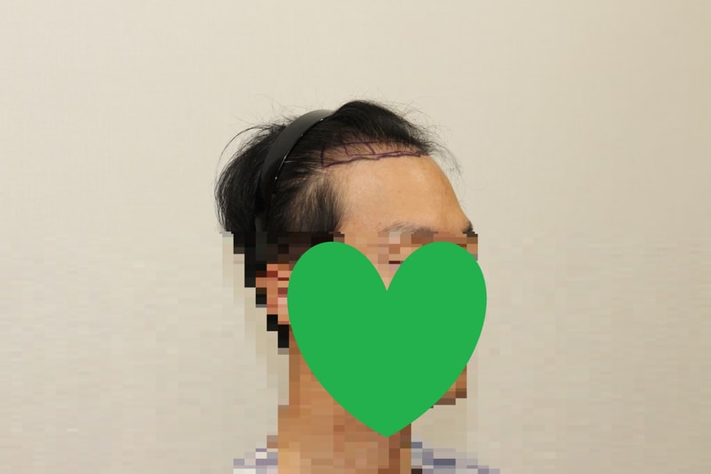 수술당일 우측.jpg
