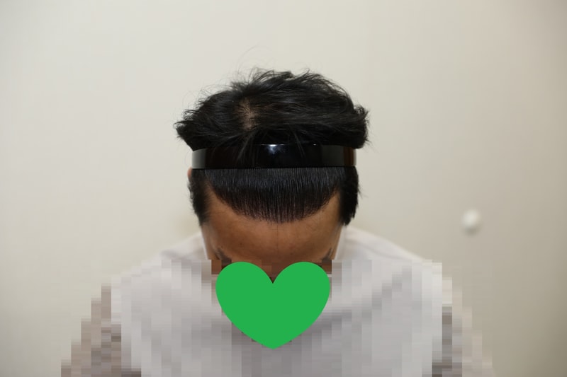 수술 1년차 위쪽.jpg