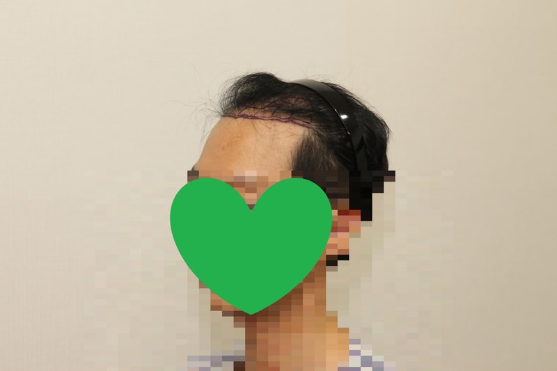 수술당일 좌측.jpg