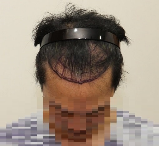 ニューヘア医院 非切開 毛髪移植 6ヵ月目のレビュー