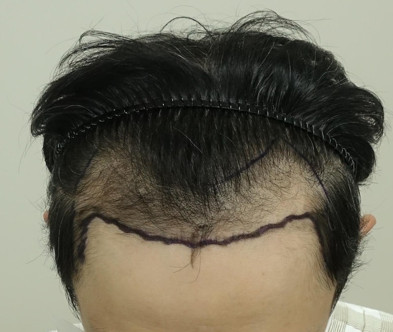 3000모낭 M자+정수리 수술전, 직후,3일후 사진입니다