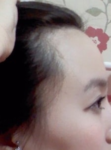 헤어라인교정전3.jpg
