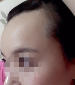 헤어라인교정전2.jpg