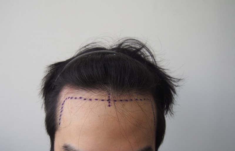 Post-mortem postoperative period immediately after maternal hair follicle surgery