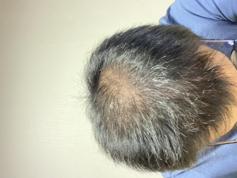 My hair is growing, but I guess it's time to wait