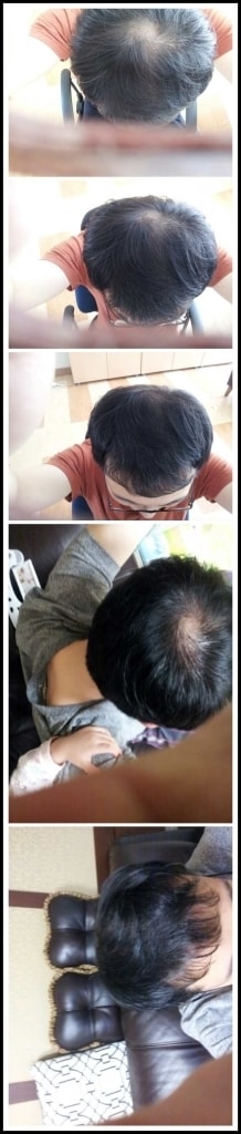 Forehead 2000 hair follicles 4 1/2 months late (Daegu)