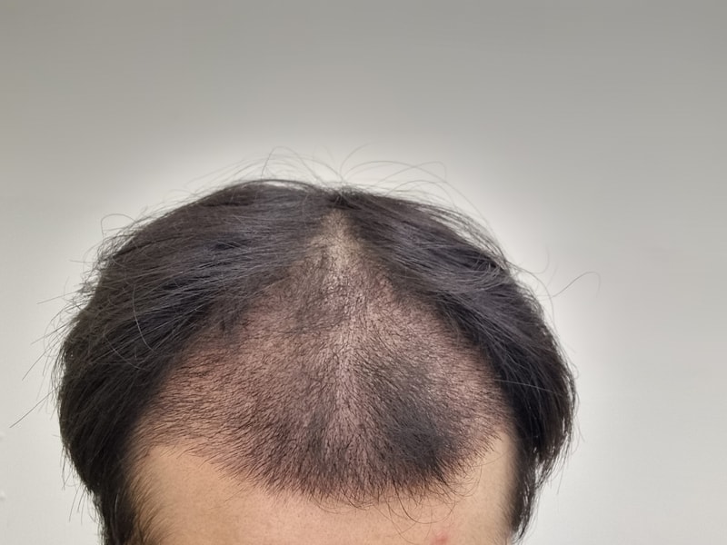 광주 압구정 모비앙 5500모 수술후기