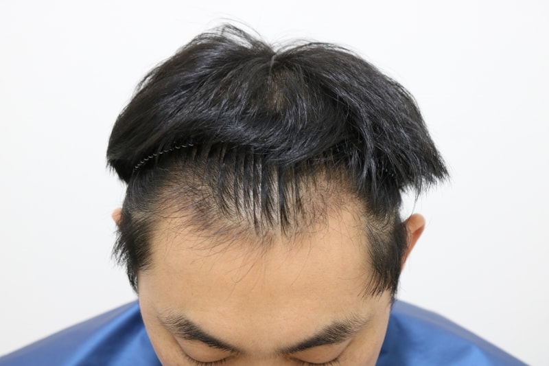 모발이식후 3개월차입니다.
