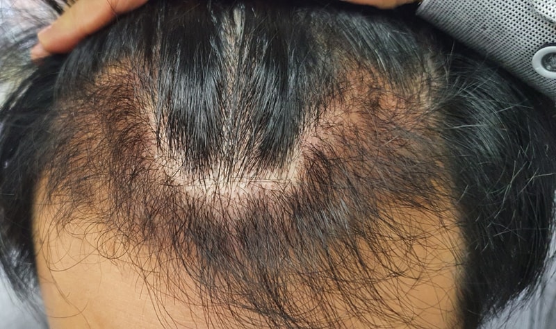 New hair non-cut 1600 hair follicles (3200 hair) 136th day elapsed