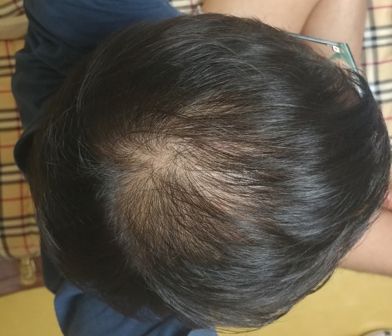 非切開4ヵ月目の病院に行ってきて、レビューを投稿します。
