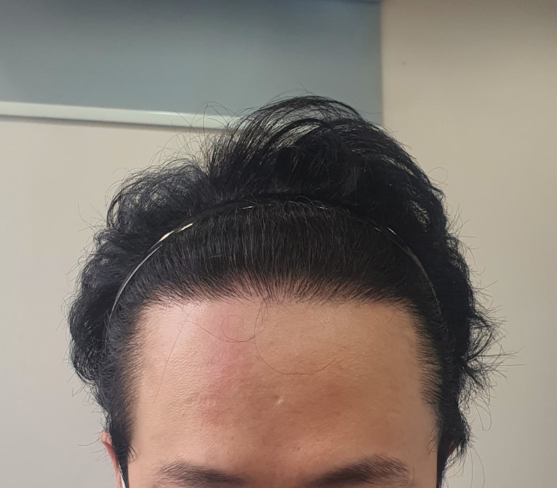 一年后期的1700毛囊