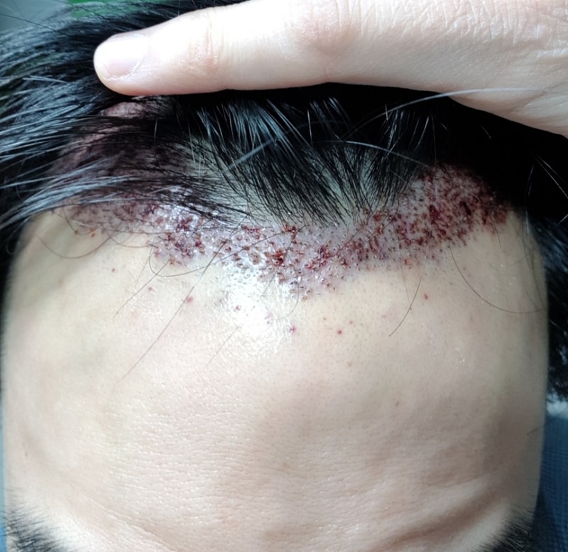 昨天终于接受了手术~！