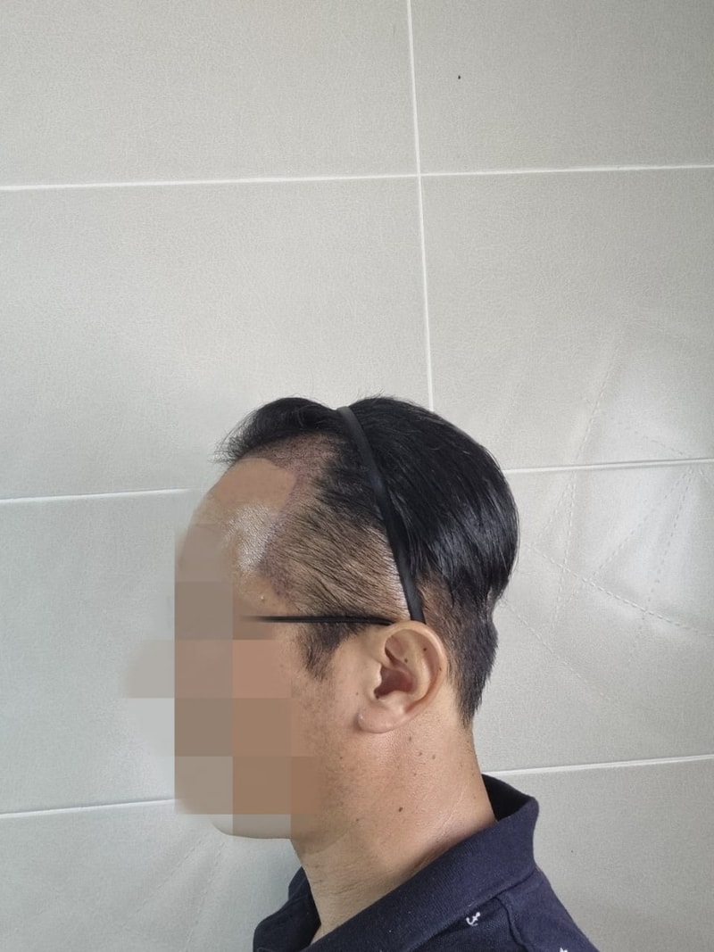 수술 후 좌측.jpg
