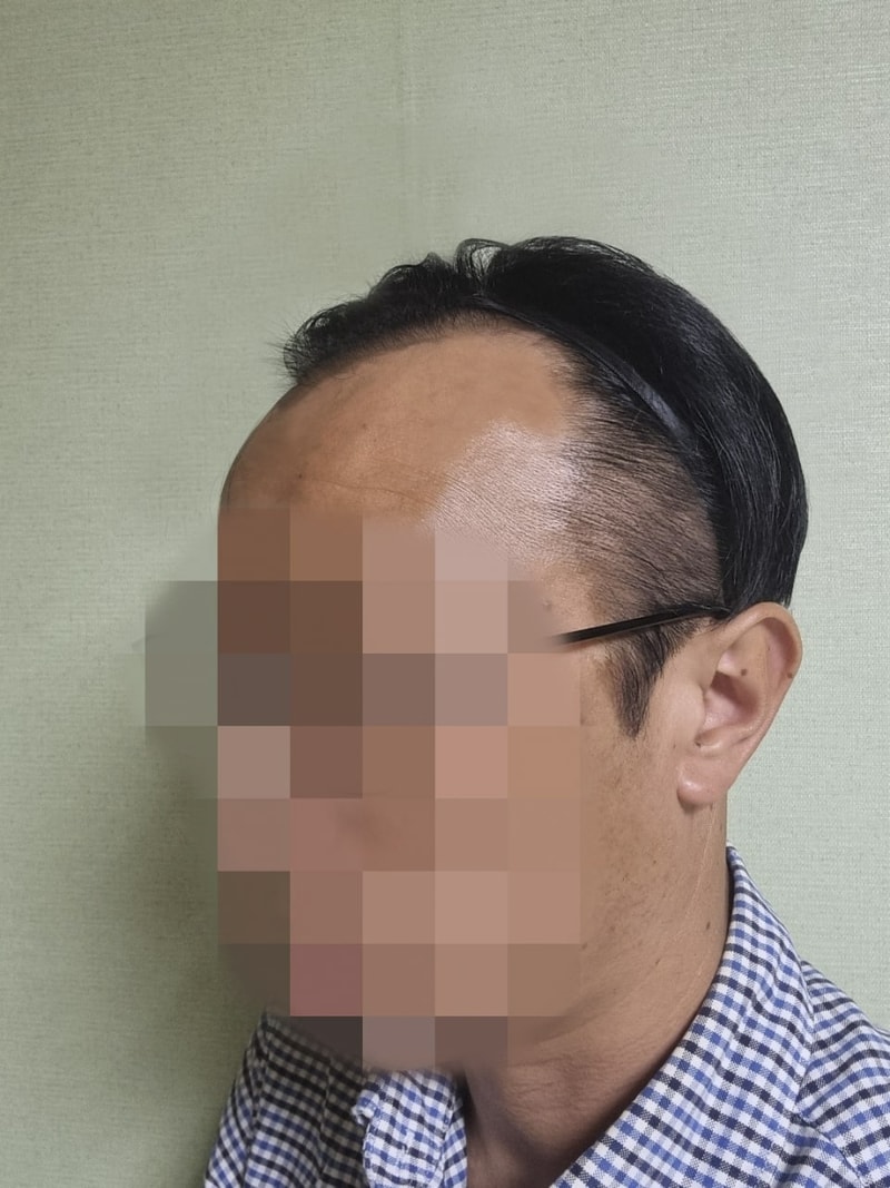 수술 전 좌측.jpg