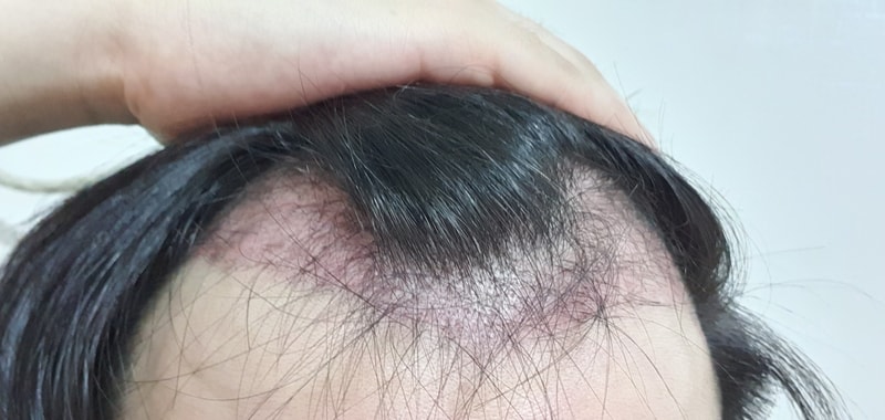 手术后已经过了一个月了~