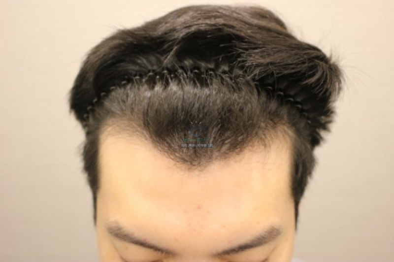 2800모 비절개 이식 8개월 경과보고