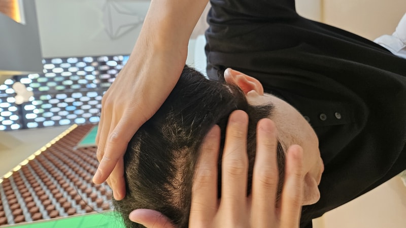 New Hair Seoul branch is in the 3rd month of non-cut hair transplantation 1,200 hair follicles