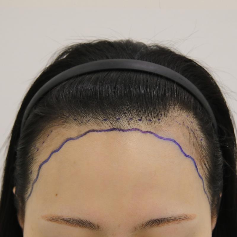 Review of Mammoth Hairline Clinic's Busan branch surgery on the same day