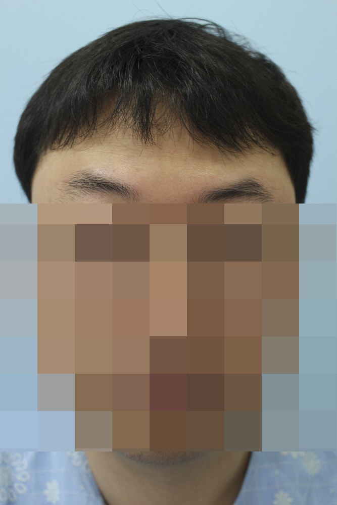 M字切開3900毛 術後の写真