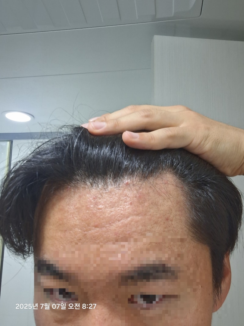 迈莫议员毛发移植第12天后记
